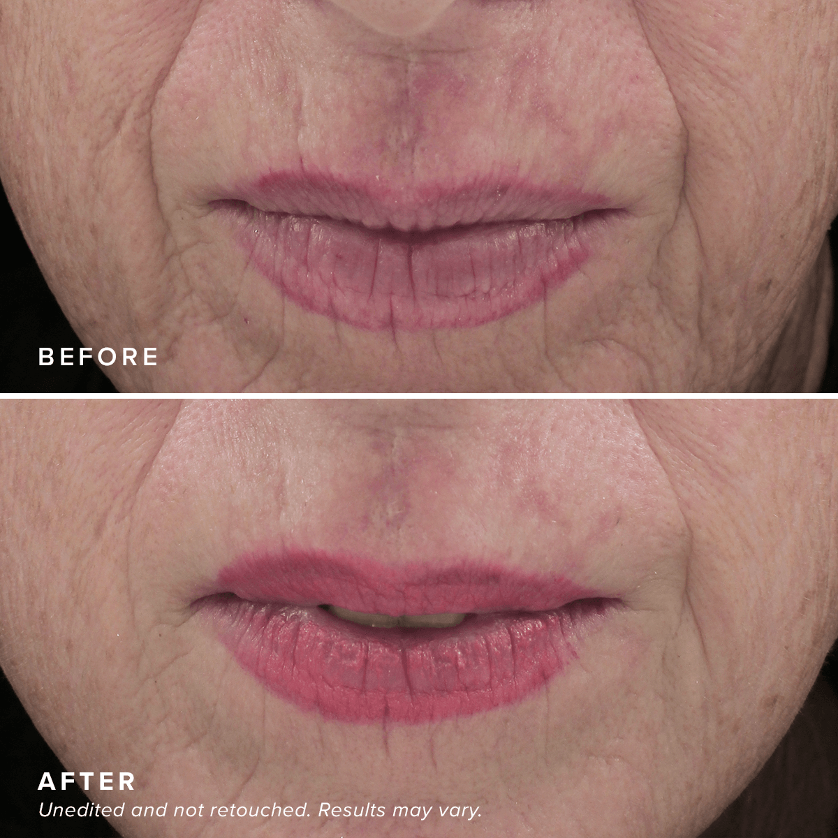 Needle-less Serum - Image 6